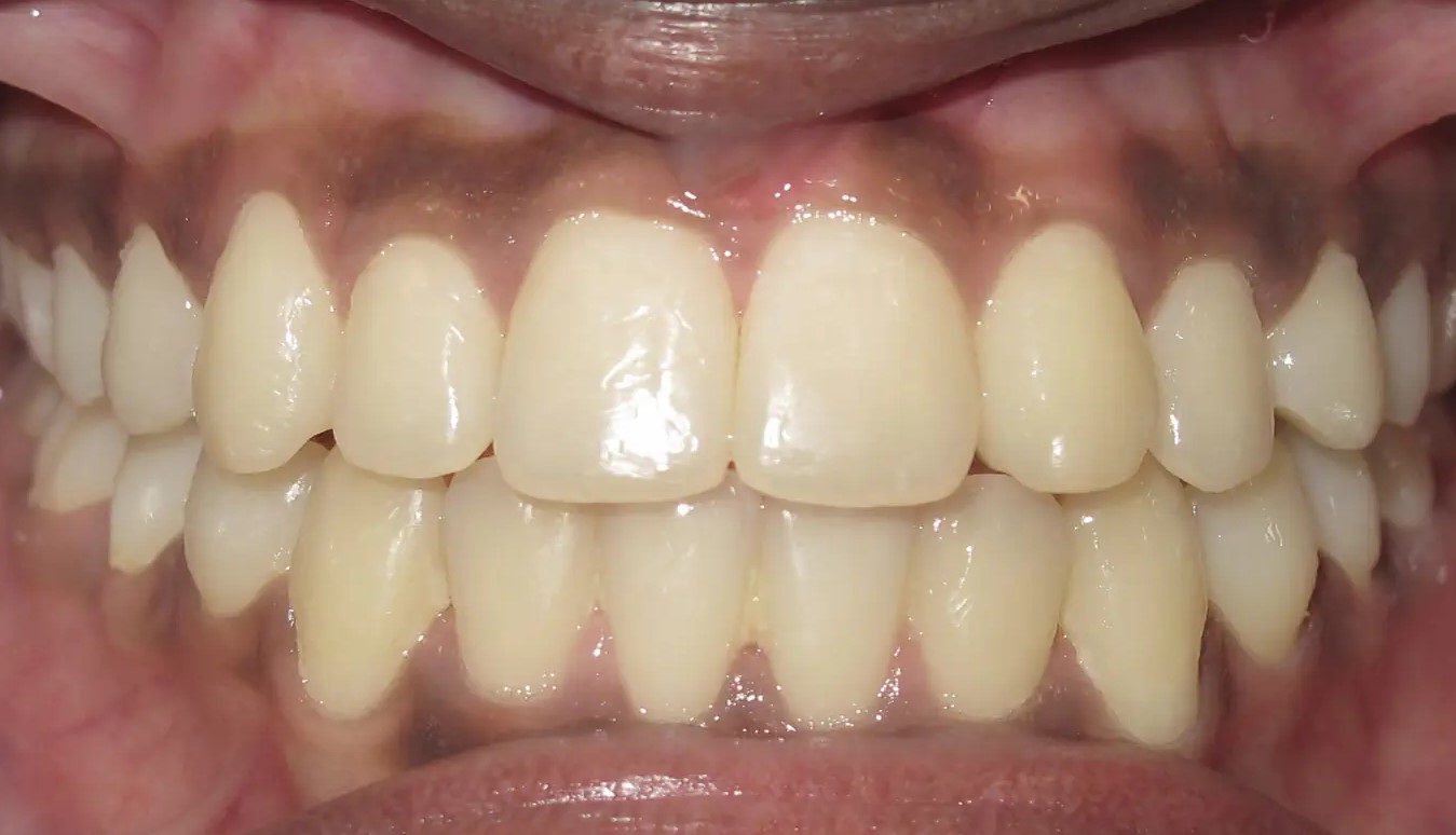 After teeth4