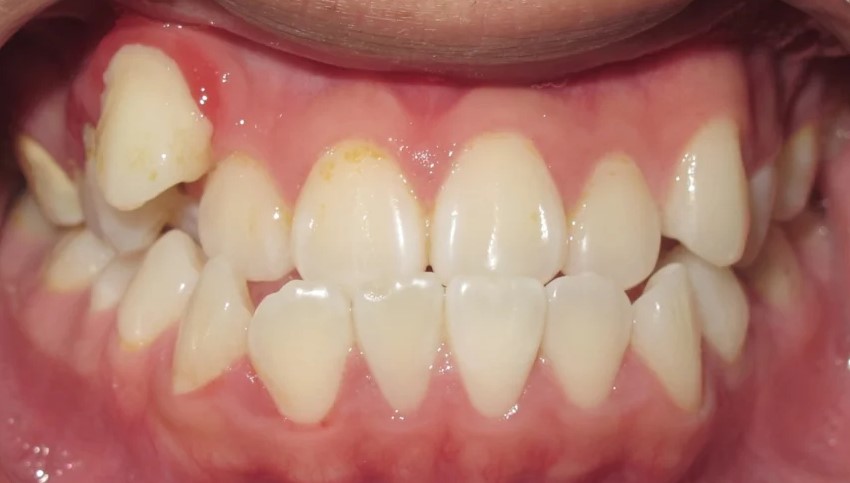 Before teeth2